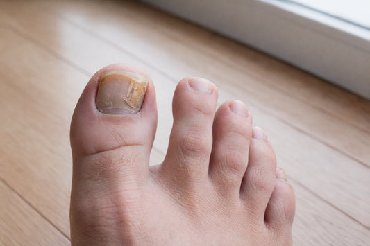 Close-up of a foot with a cracked toenail on a wooden floor.